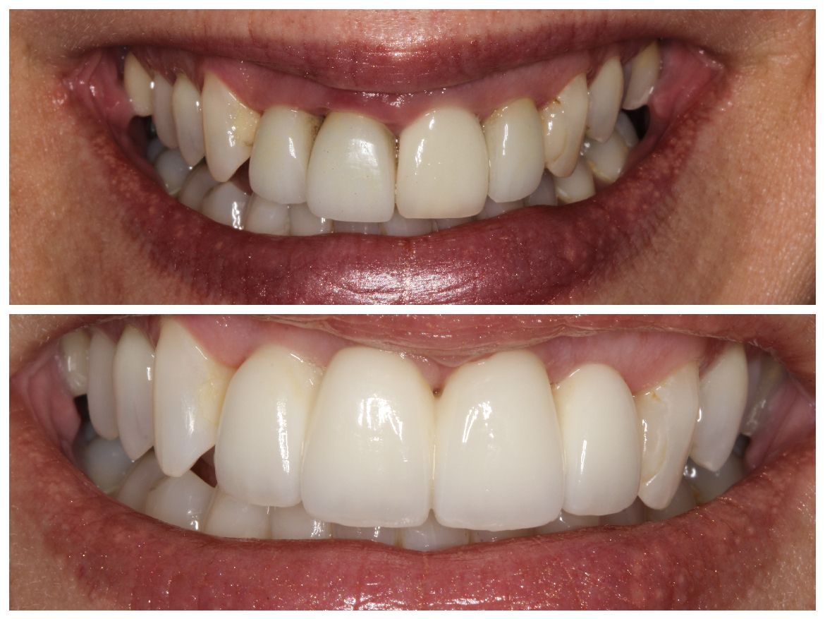 Comparison of teeth before and after cosmetic dental work, showcasing straighter, whiter teeth.