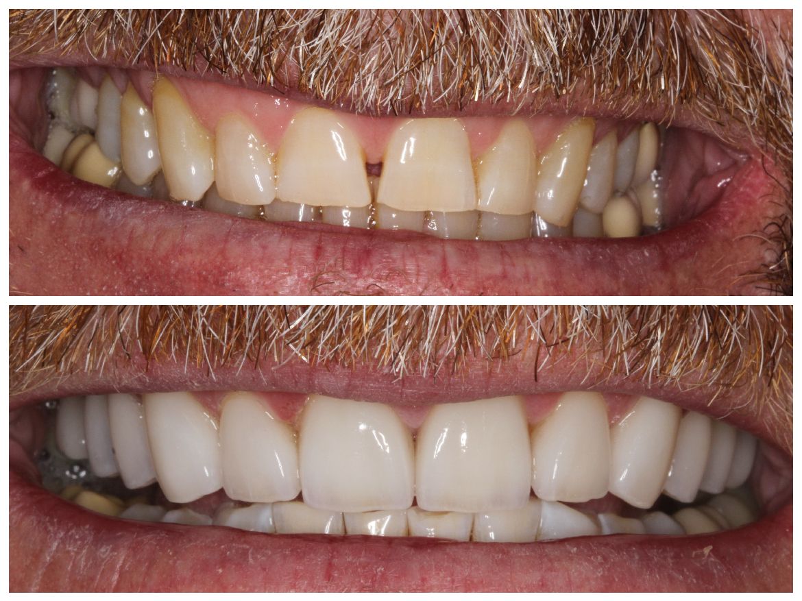 Side-by-side comparison of teeth. Top: crooked, yellowed teeth. Bottom: straight, white teeth.