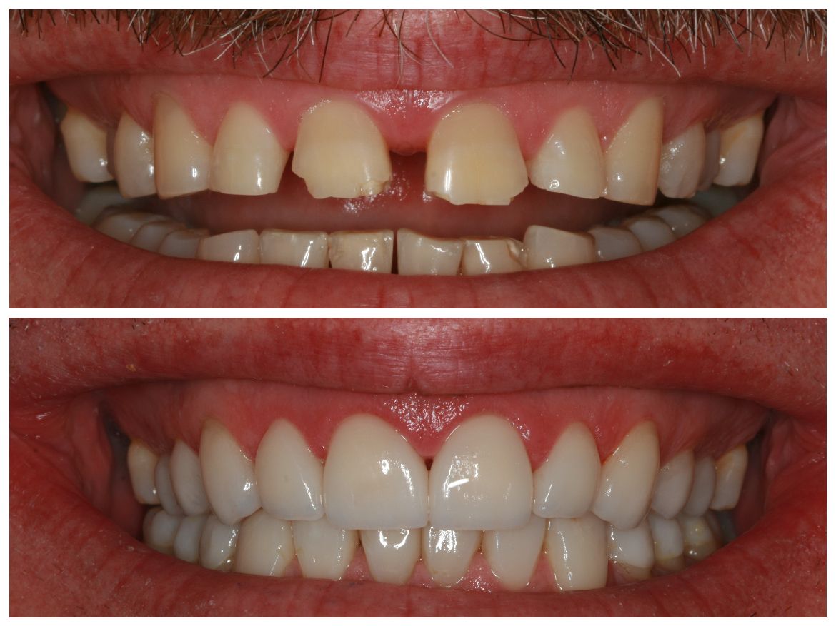 Before-and-after of a person's teeth. Top: chipped, gapped teeth. Bottom: replaced with straight, white teeth.