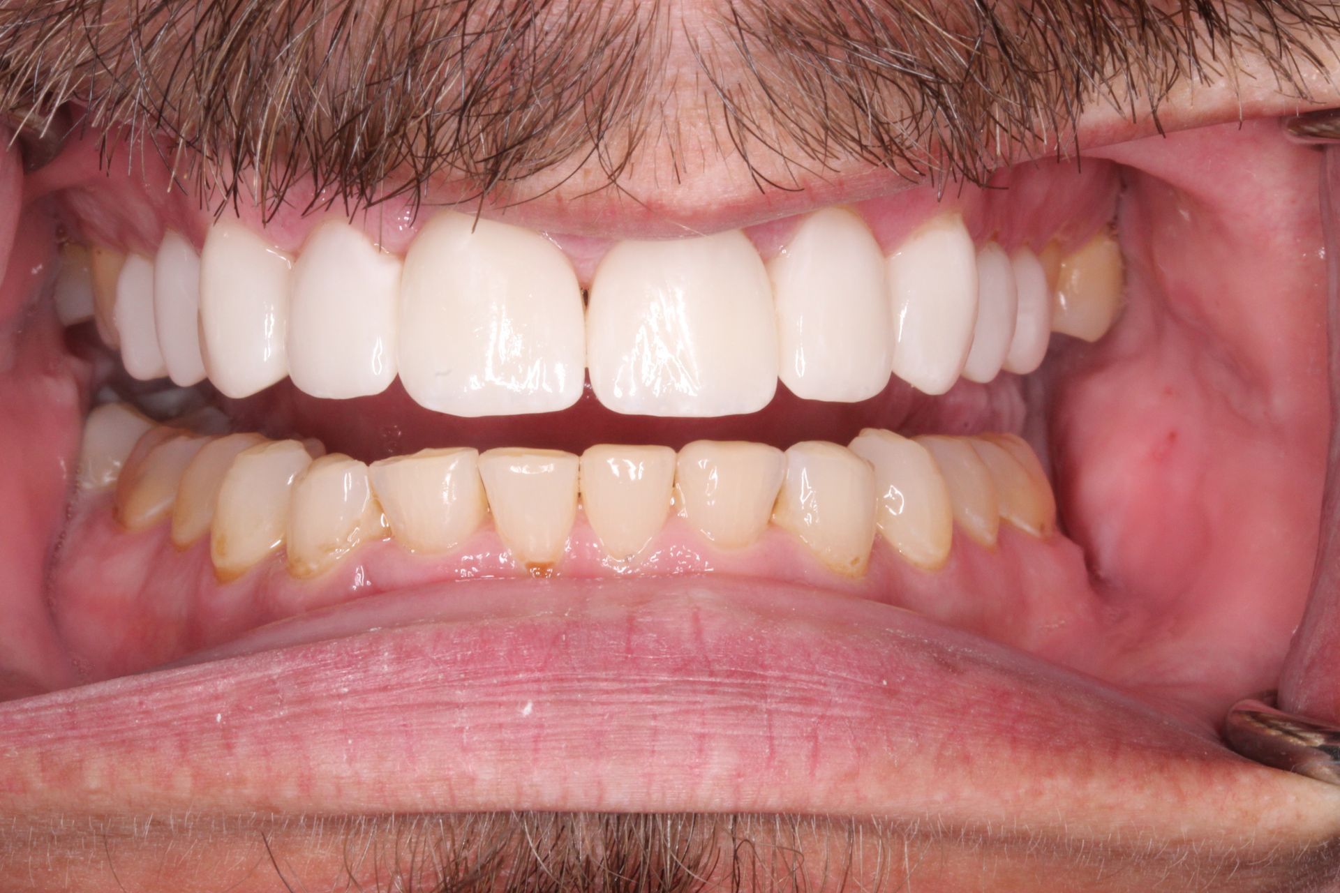 Close-up of a person's teeth. The top teeth are white and aligned. The bottom teeth are yellowed.