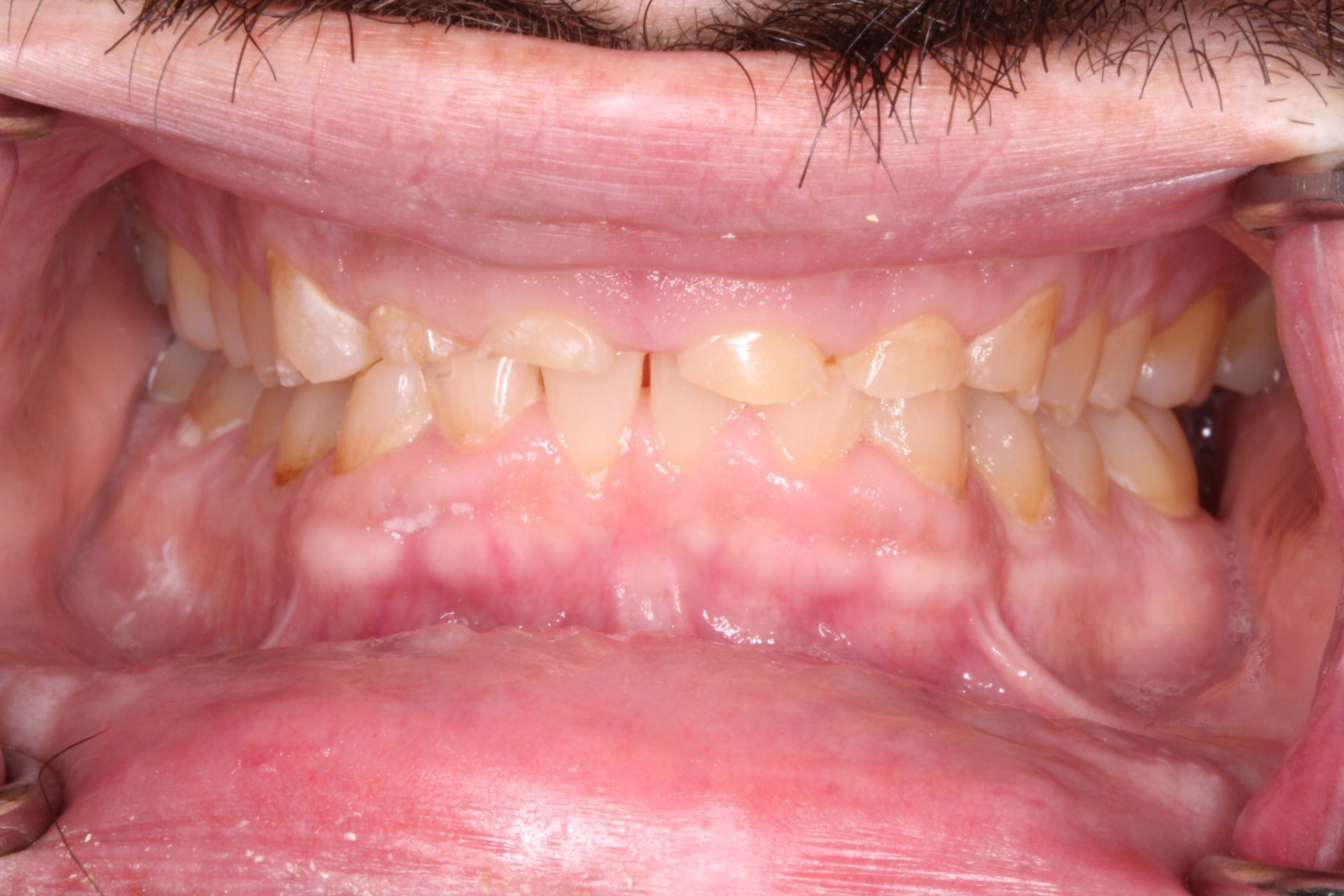 Mouth close-up showing teeth and gums. Teeth are discolored with visible gaps and wear. Gums are pink and appear inflamed.