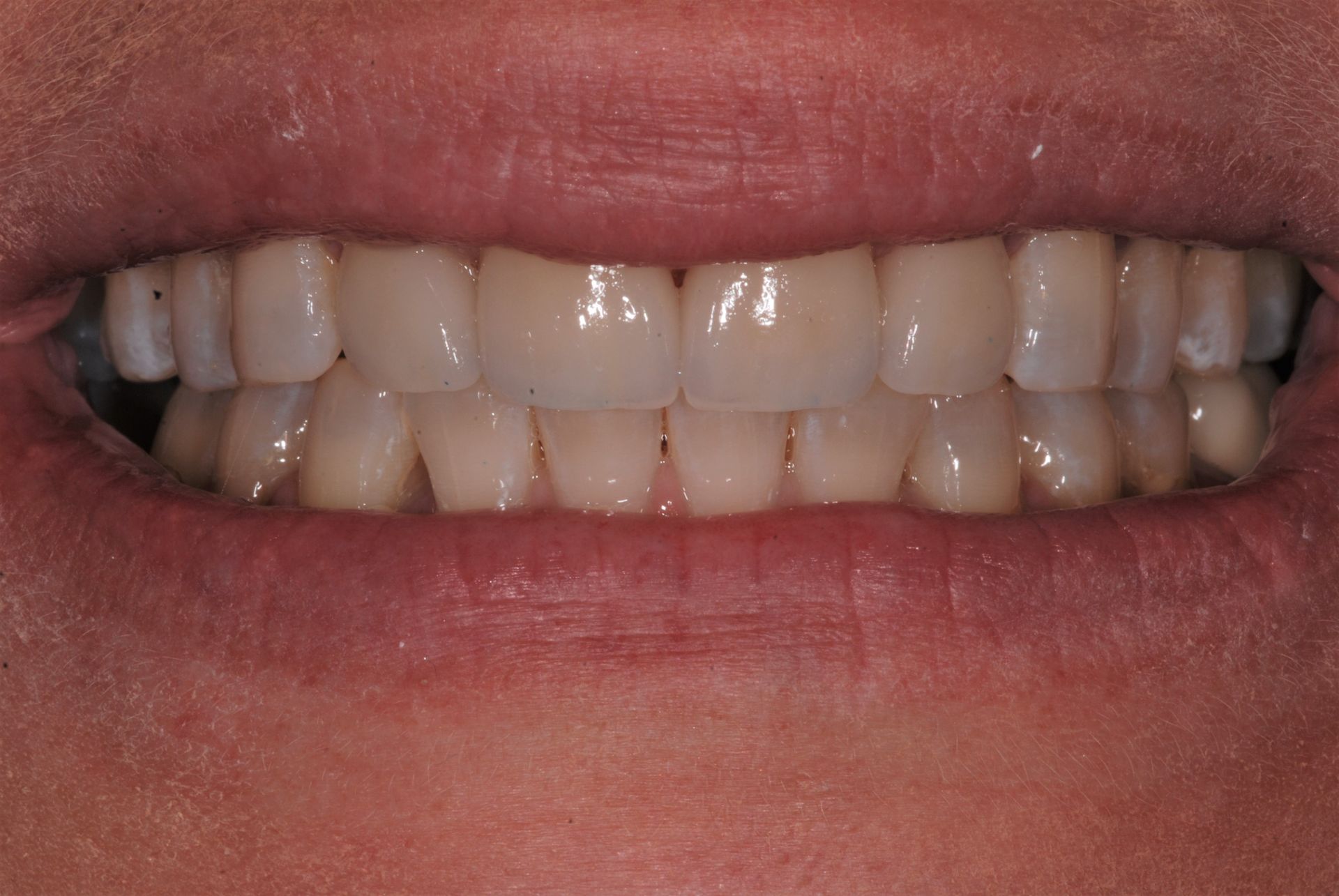 Close-up of a person's mouth with visible teeth. The teeth appear healthy and white with a slightly yellow tinge.