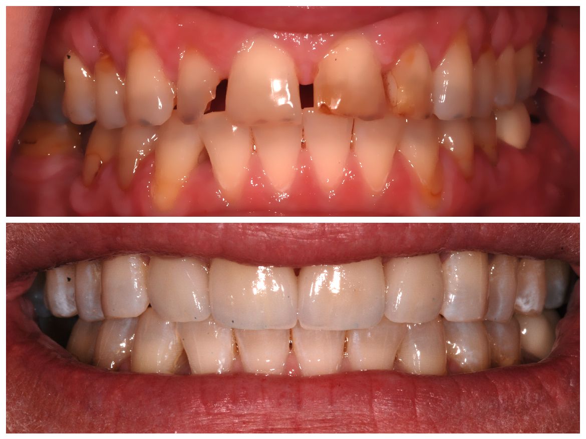 Before and after photos of teeth. Top shows damaged, discolored teeth. Bottom shows healthy, white teeth.