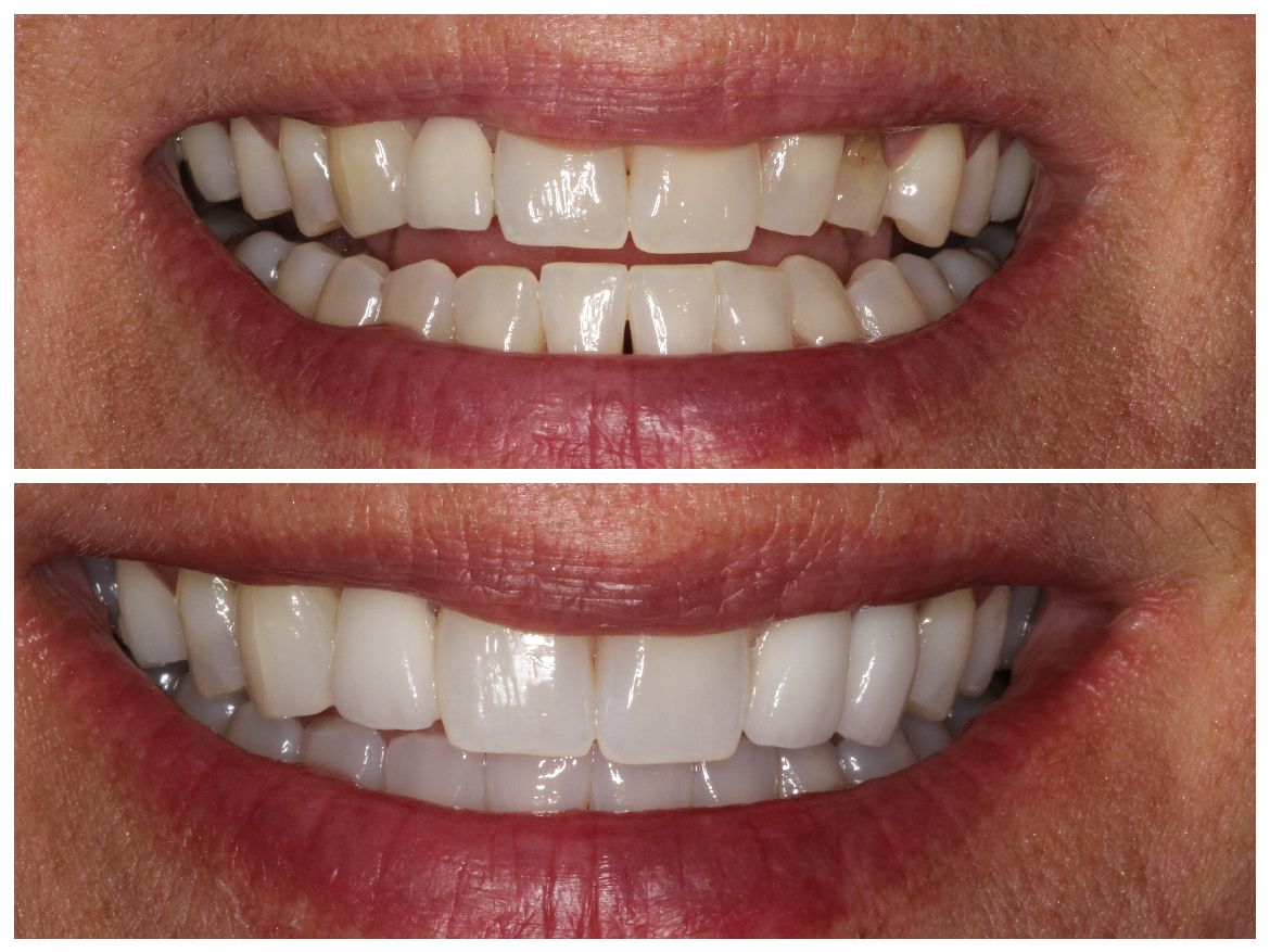 Before and after images of a smile with damaged teeth repaired to a bright, healthy look.