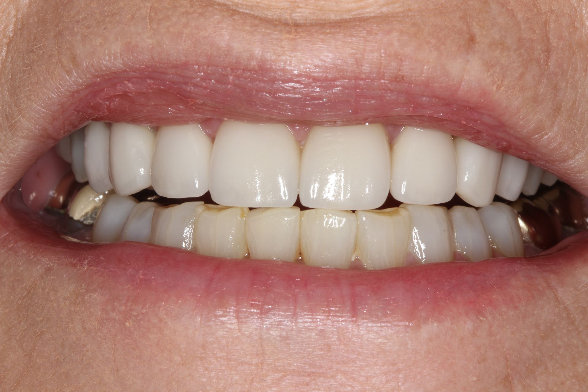 Close-up of a person's mouth, showing upper and lower teeth. Upper teeth are white, lower teeth are yellowish.