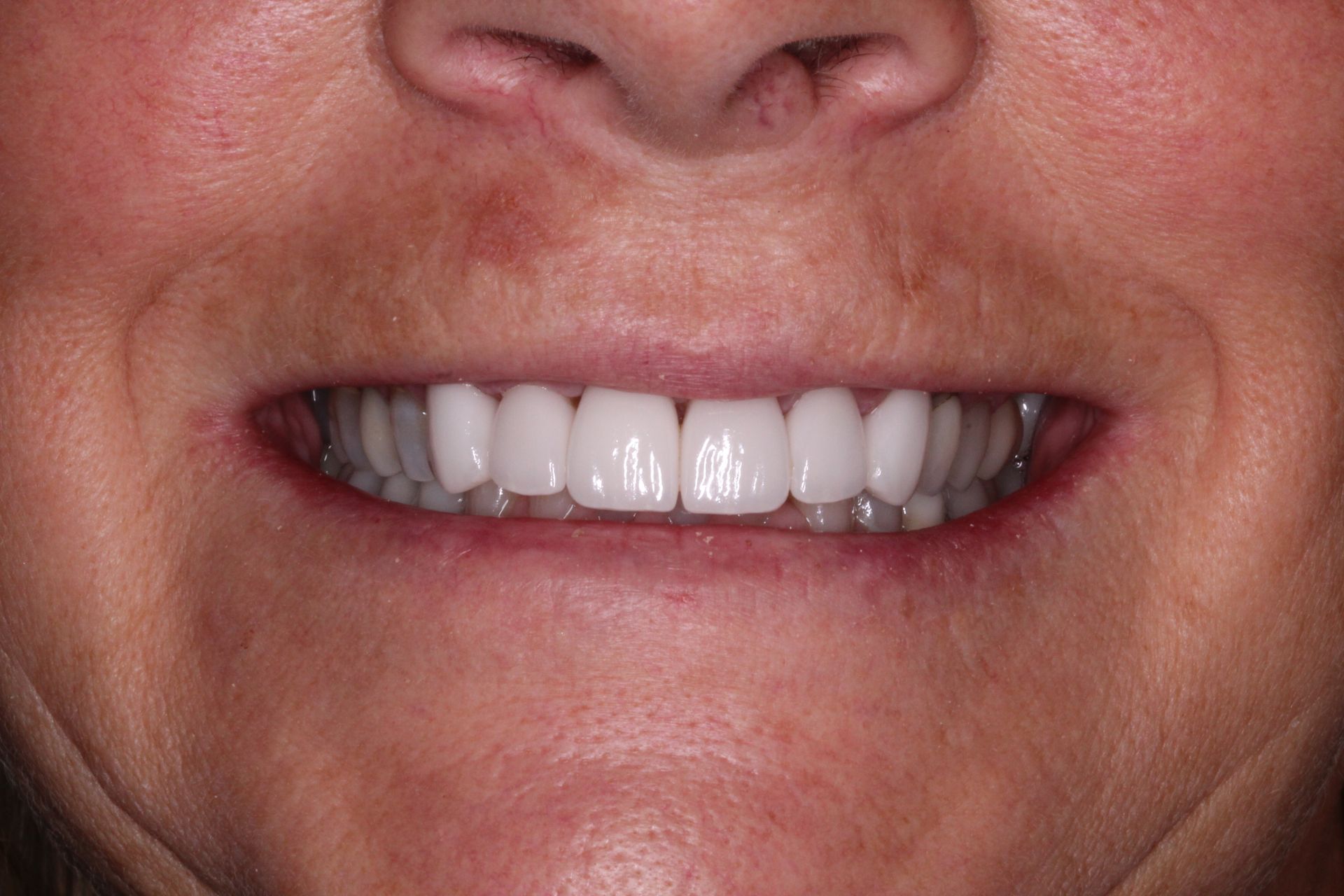Close-up of a person's mouth with bright, white teeth visible in a slight smile.