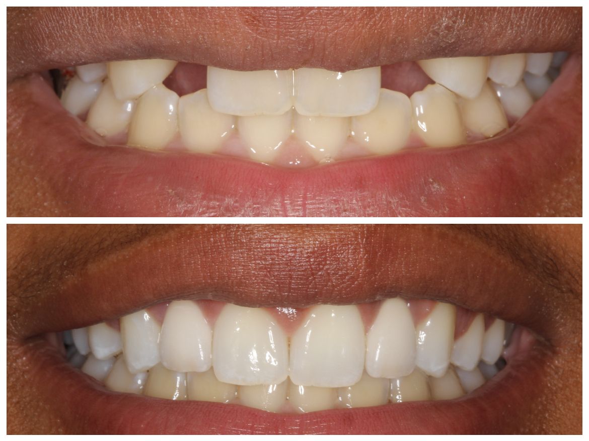 Before and after photos of teeth: Upper shows misaligned teeth, lower shows a straight, white smile.