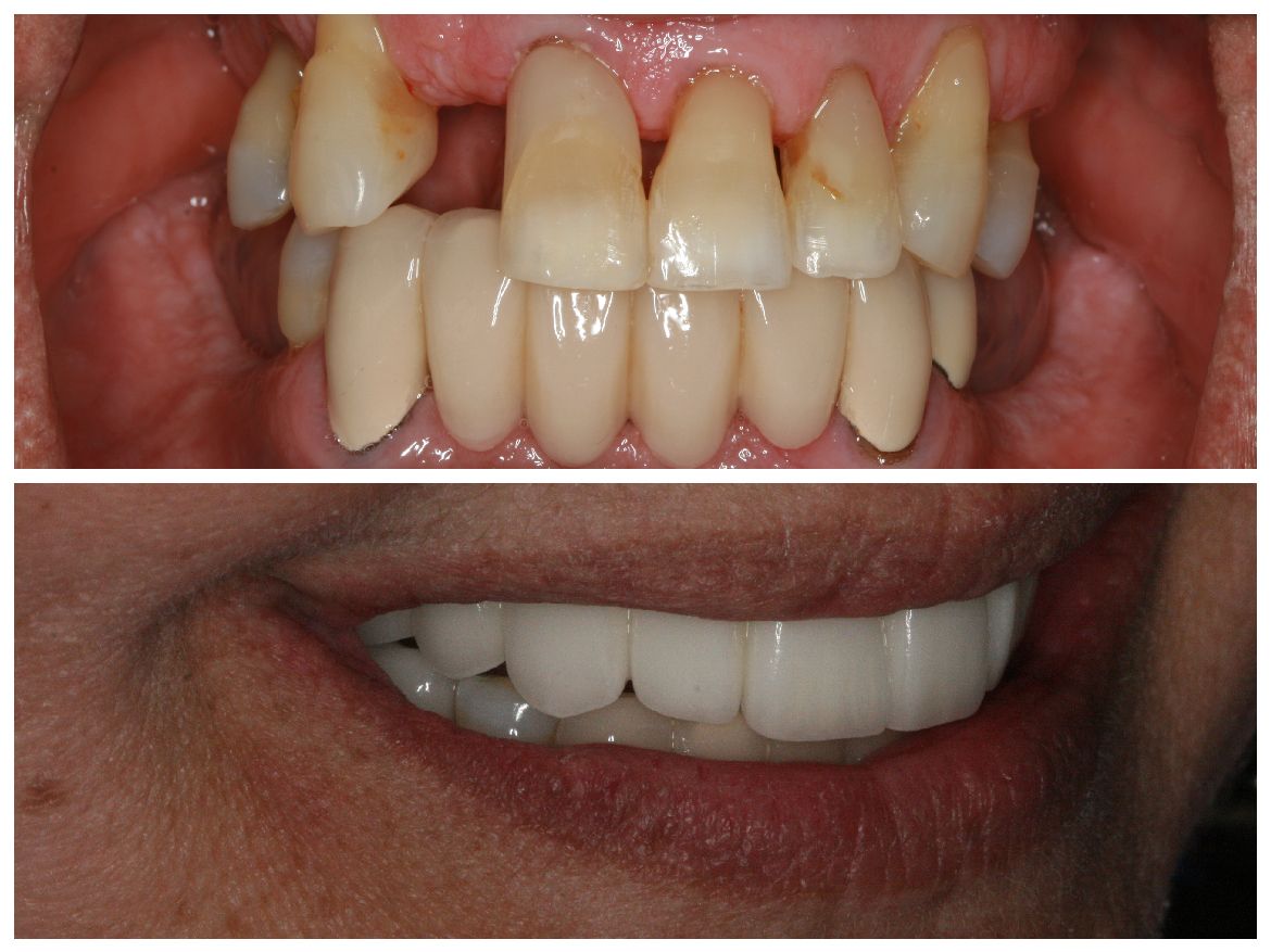 Before and after dental work: Upper teeth visible, with a gap and discoloration, versus a bright smile.