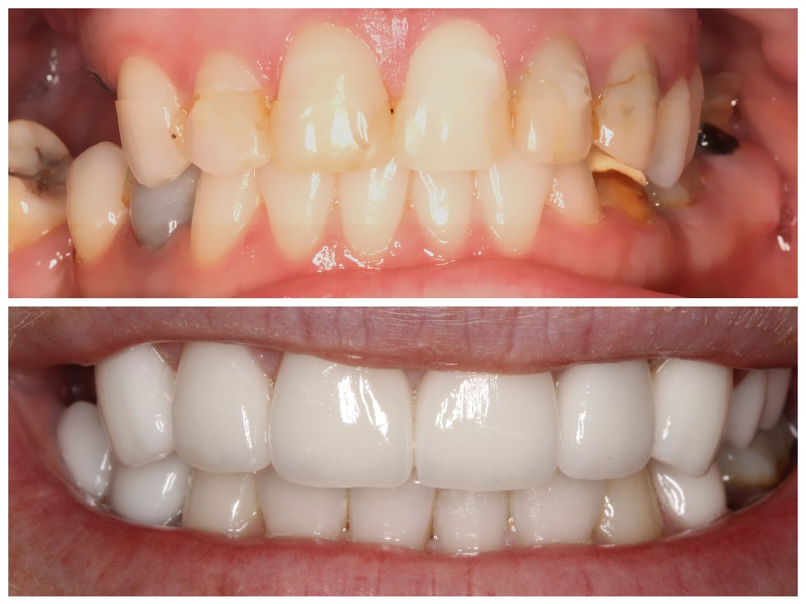 Before and after comparison of teeth. Upper image shows discolored teeth. Lower image shows bright, white teeth.