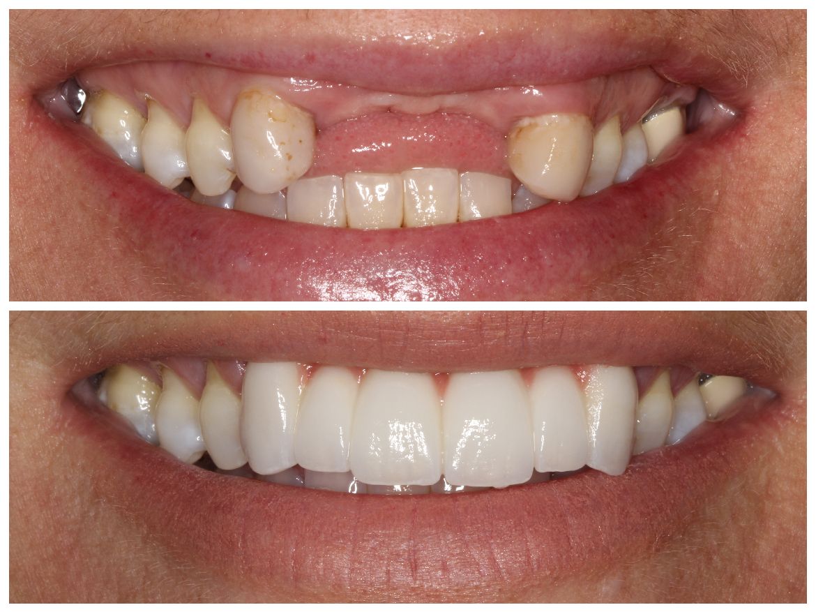 Top: Mouth with missing front teeth, discolored. Bottom: New, bright white teeth.