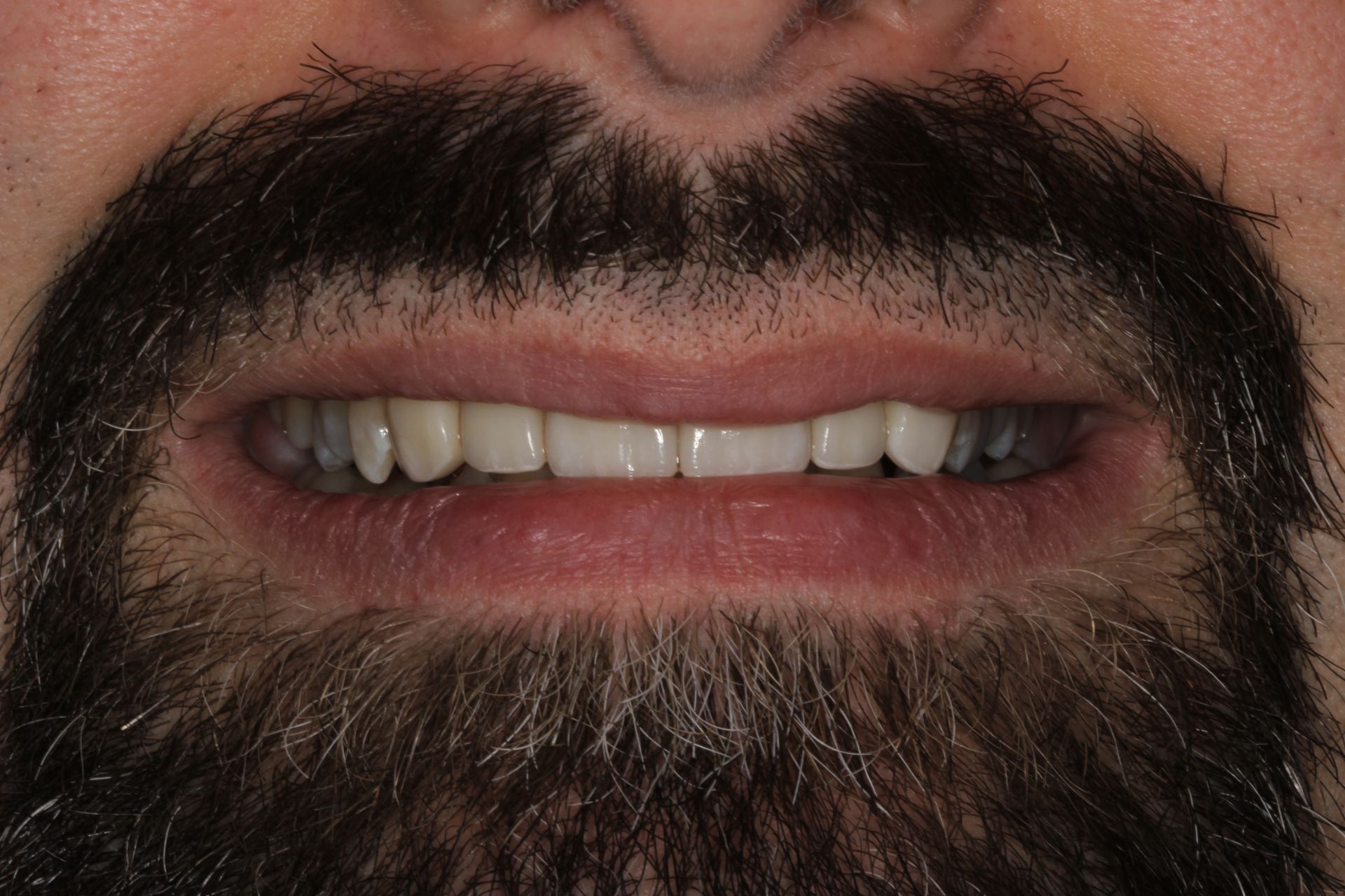 Close-up of a person's smiling mouth showing white teeth, surrounded by a dark beard and mustache.