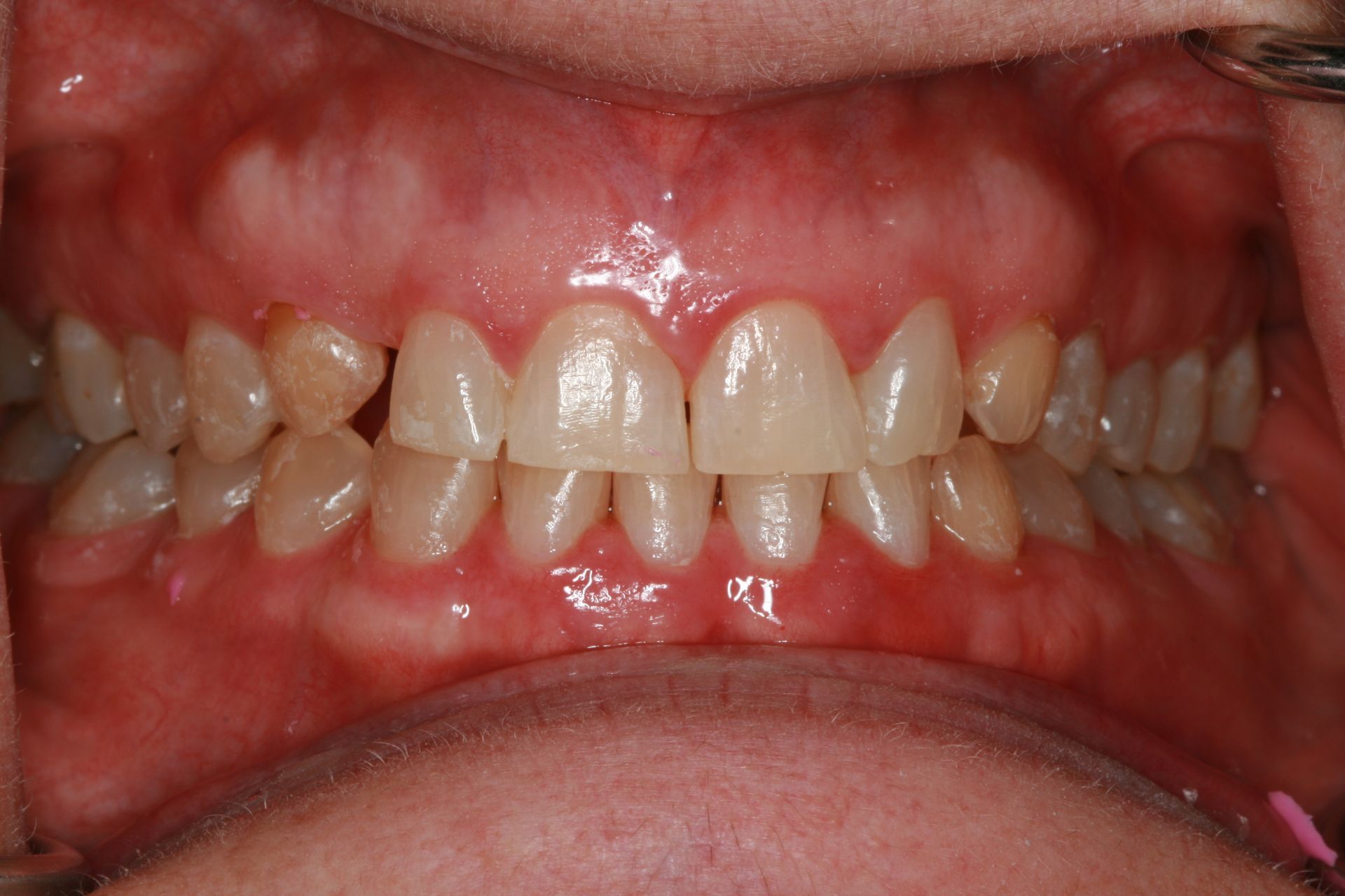Close-up of human teeth, showing an upper and lower set. Gums are pink, teeth are white, some are crooked.