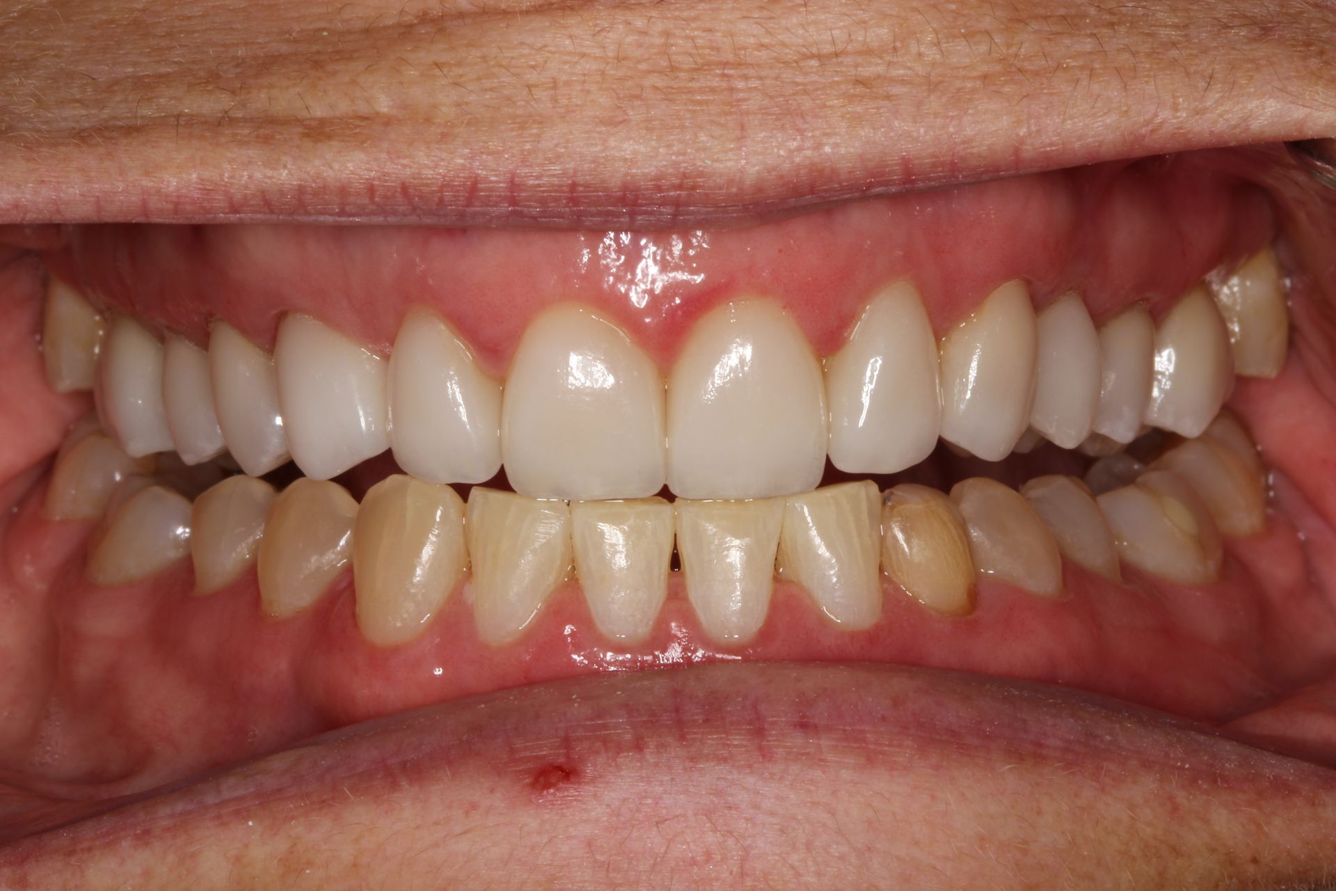 Close-up of teeth. Upper teeth are white, lower teeth are yellowish. Mouth is open, showing gums.