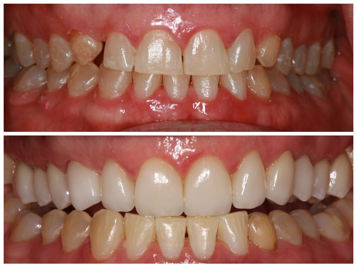 Before and after photos of a person's teeth. Top: crooked, yellow teeth. Bottom: straight, white teeth.