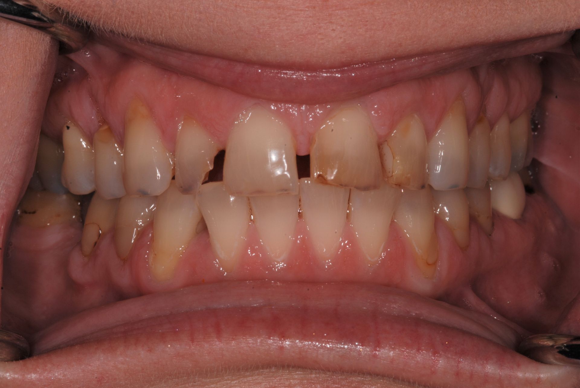 Close-up of teeth with discoloration, chips, and uneven wear. Pink gums and visible lips.