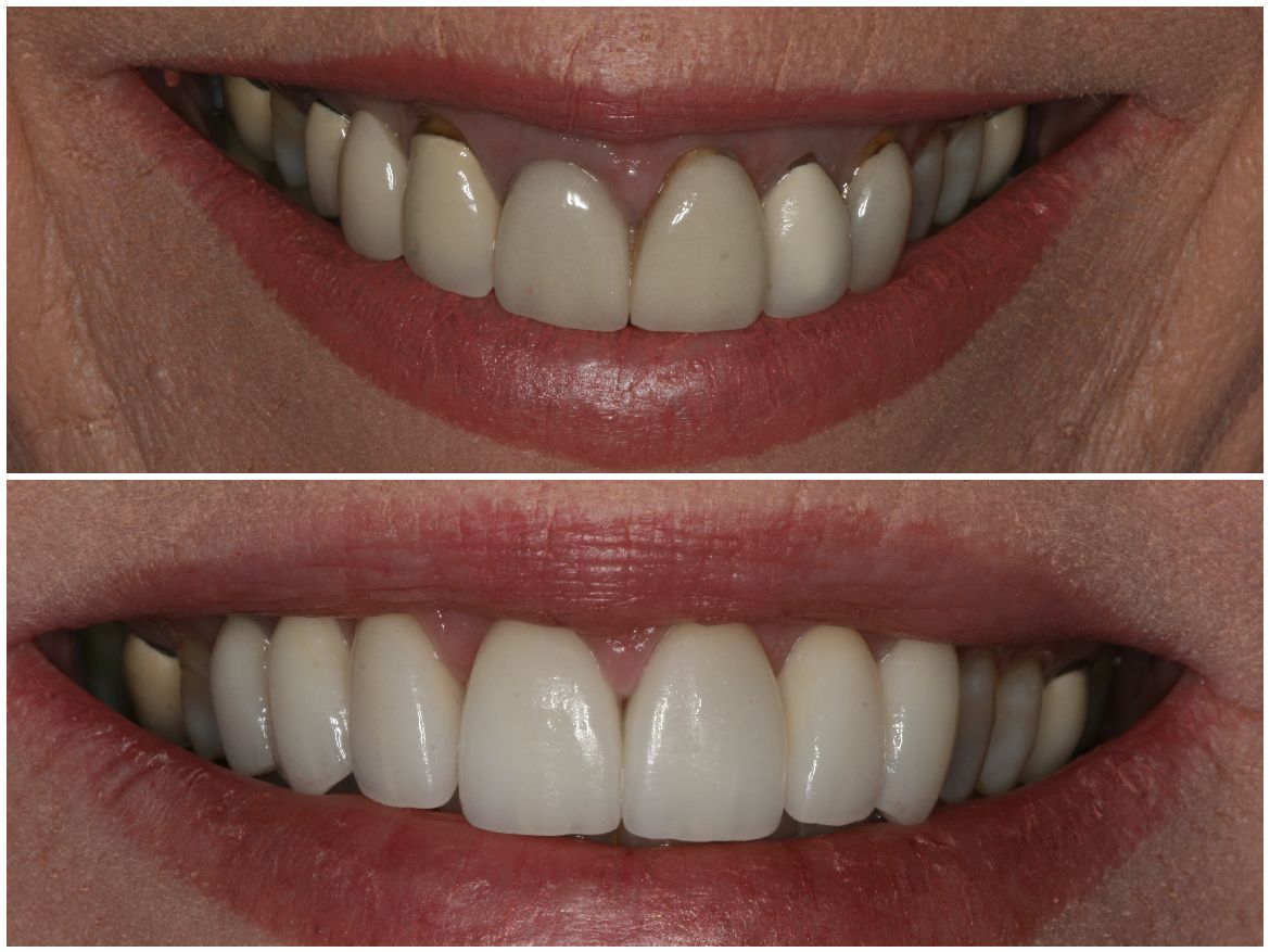 Before-and-after of a person's smile, showing teeth with cosmetic dental work; upper teeth are improved.