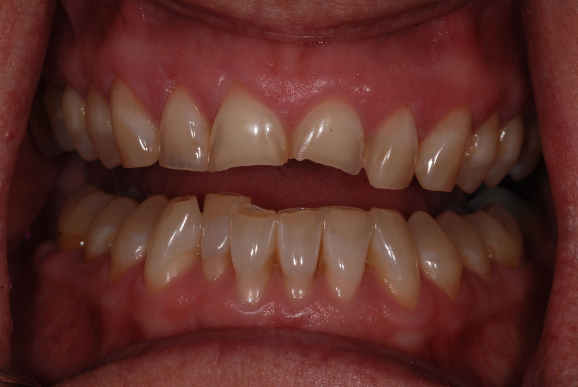 Mouth with teeth showing a chipped front tooth; gums are visible and pink.