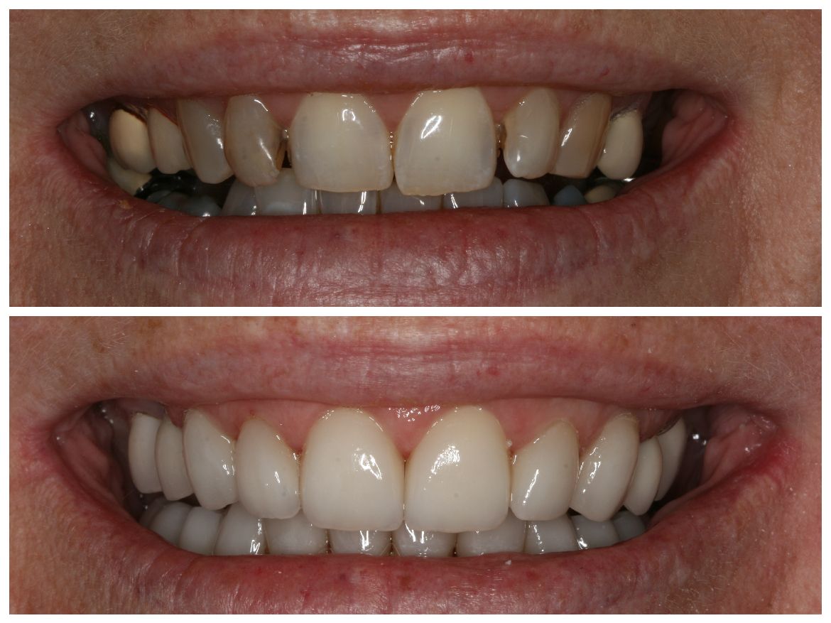 Before-and-after of a person's smile, showing stained, crooked teeth improved to a bright, even appearance.