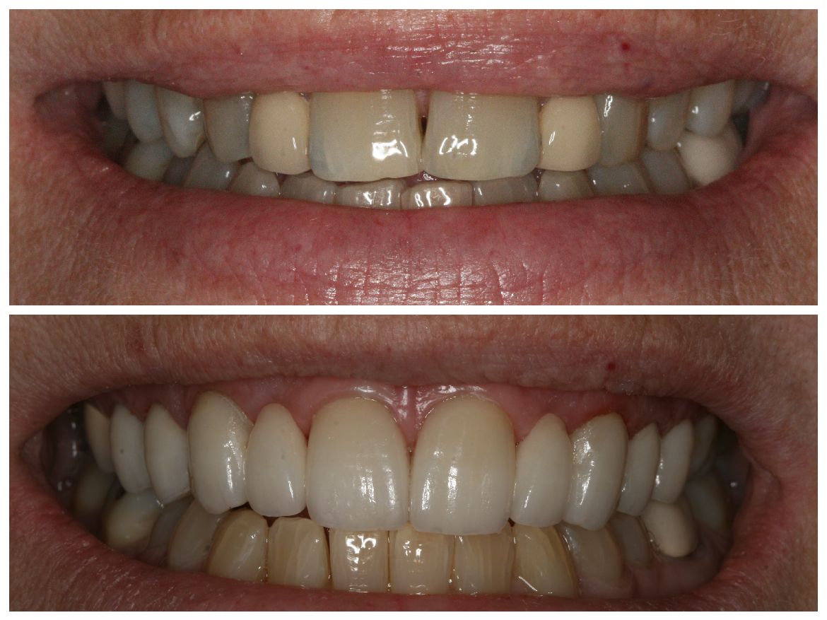 Top: Crooked teeth. Bottom: Straight, bright teeth. Comparison of a smile before and after dental work.