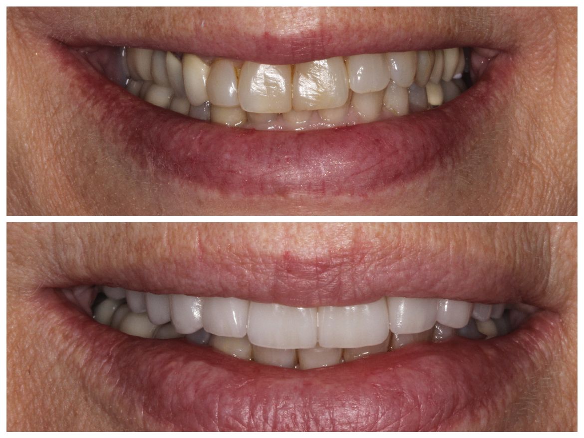 Comparison of teeth before and after cosmetic dental work, showing a brighter smile.
