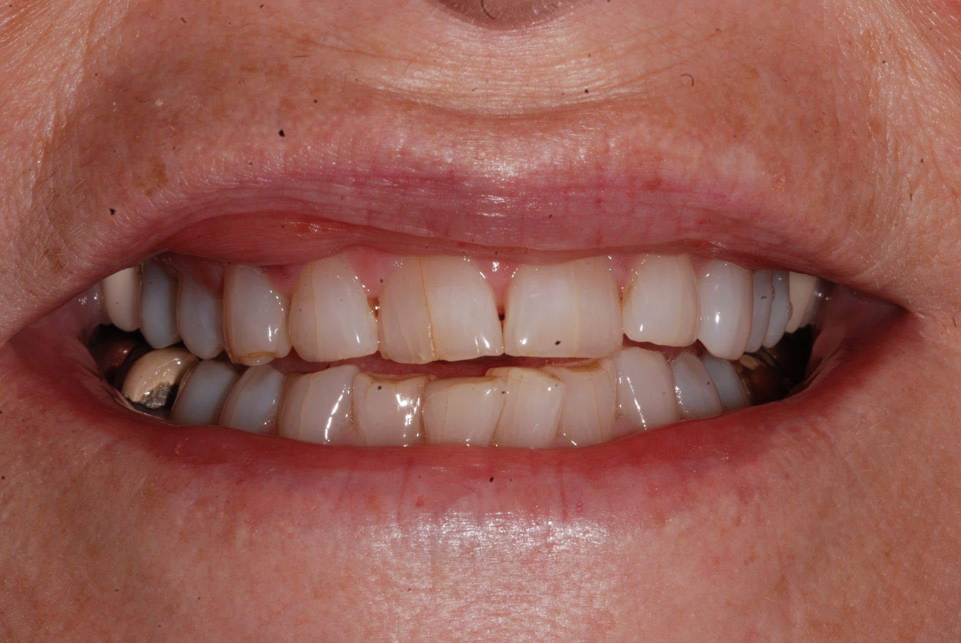 Open mouth showing teeth with discoloration and minor damage.
