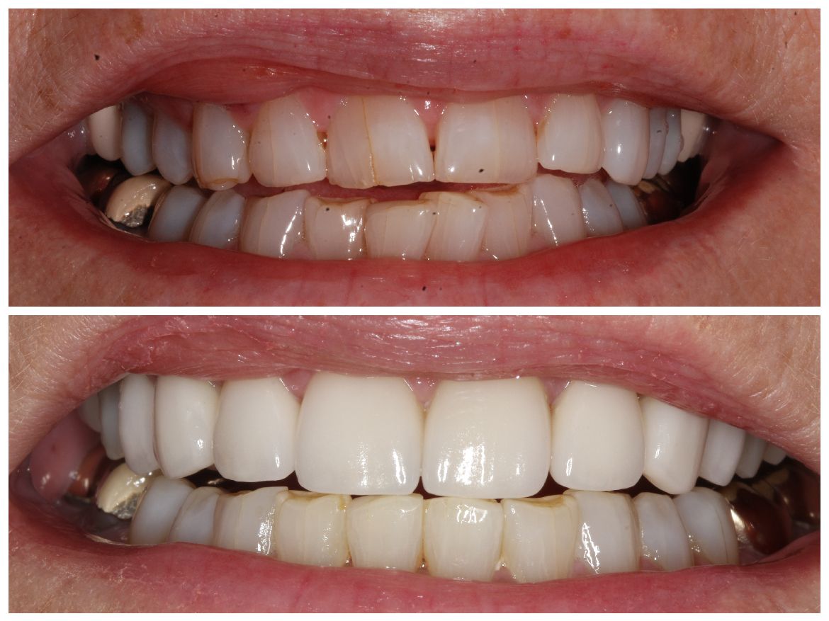 Side-by-side dental comparison: Before with stained teeth, and after with bright, white teeth.