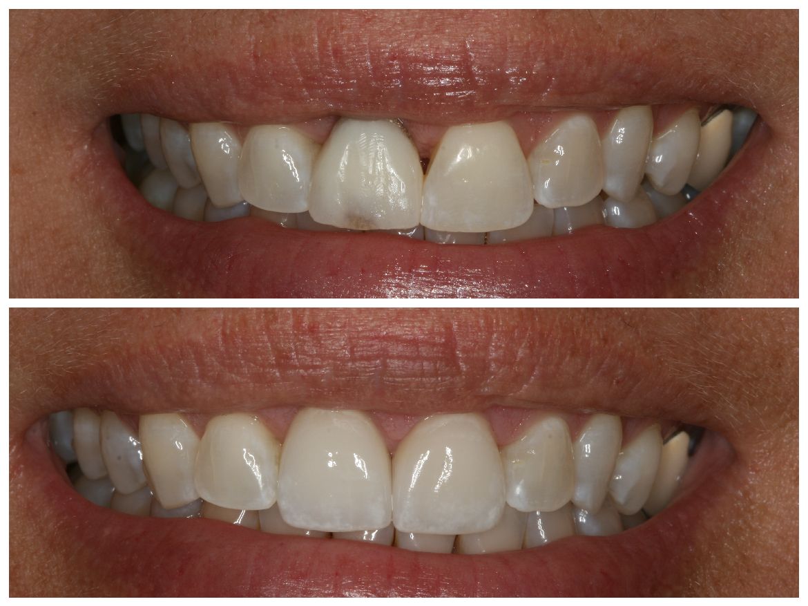 Comparison of teeth: before (top) and after (bottom) cosmetic dental work. Teeth appear whiter and more aligned.