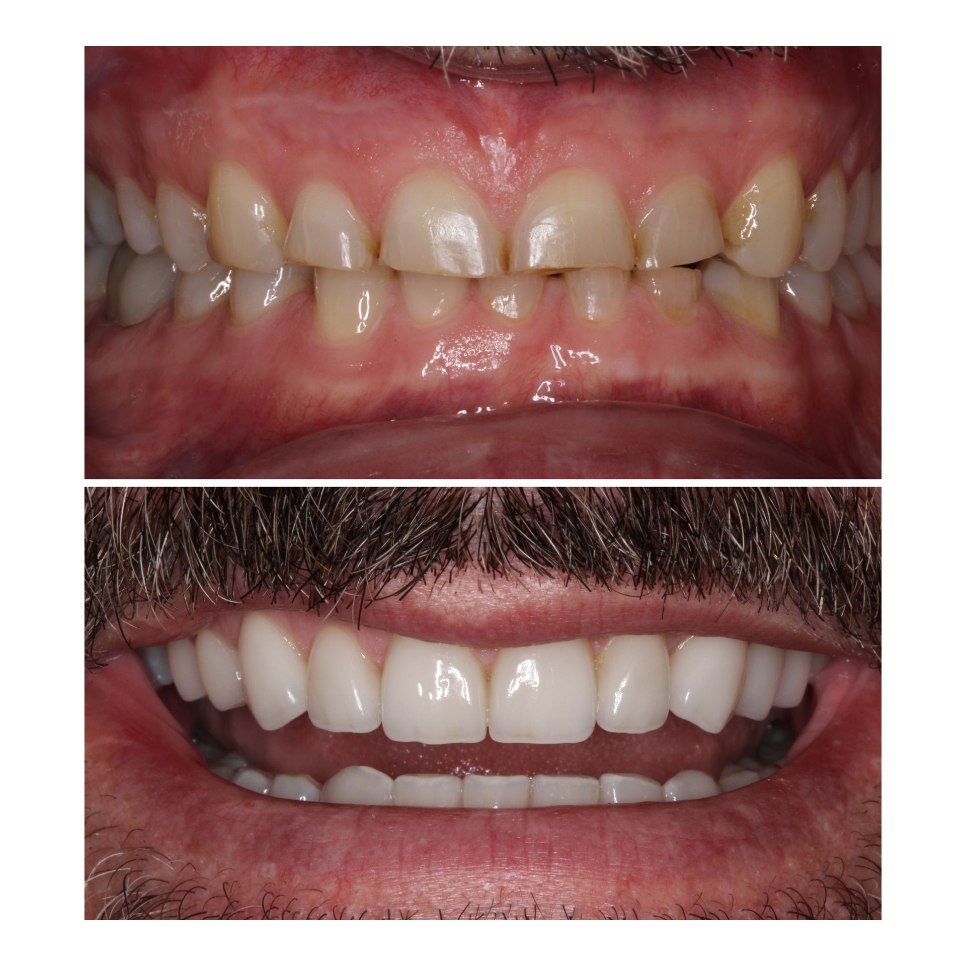 Before and after photos of teeth: yellow, uneven teeth compared to bright, white smile.