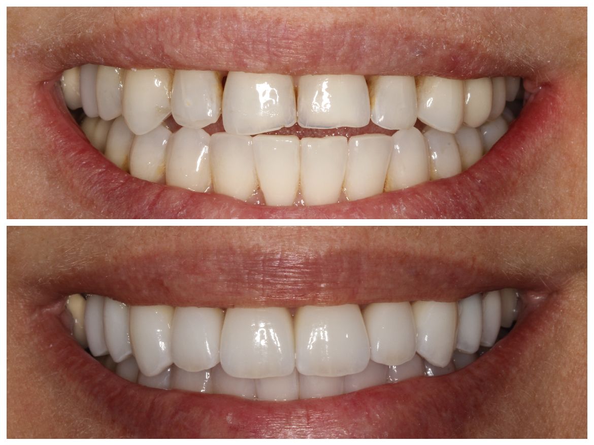 Before and after teeth whitening: top shows stained teeth; bottom shows bright, white teeth.