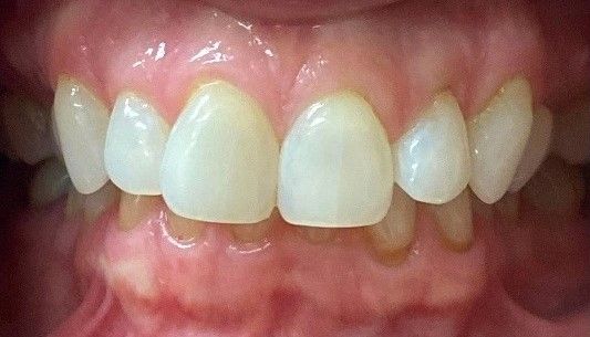 A close-up of a person's teeth with white teeth - before