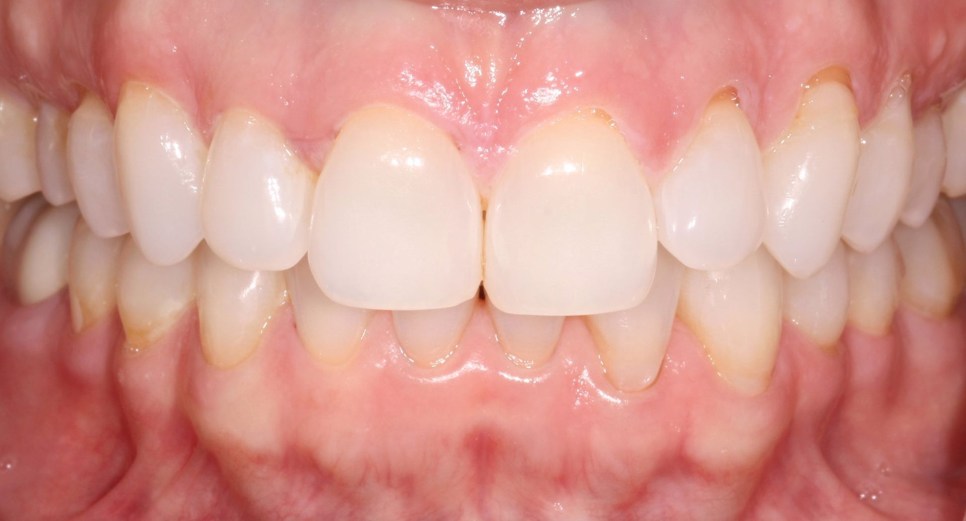 A close-up of a person's teeth with white teeth - after