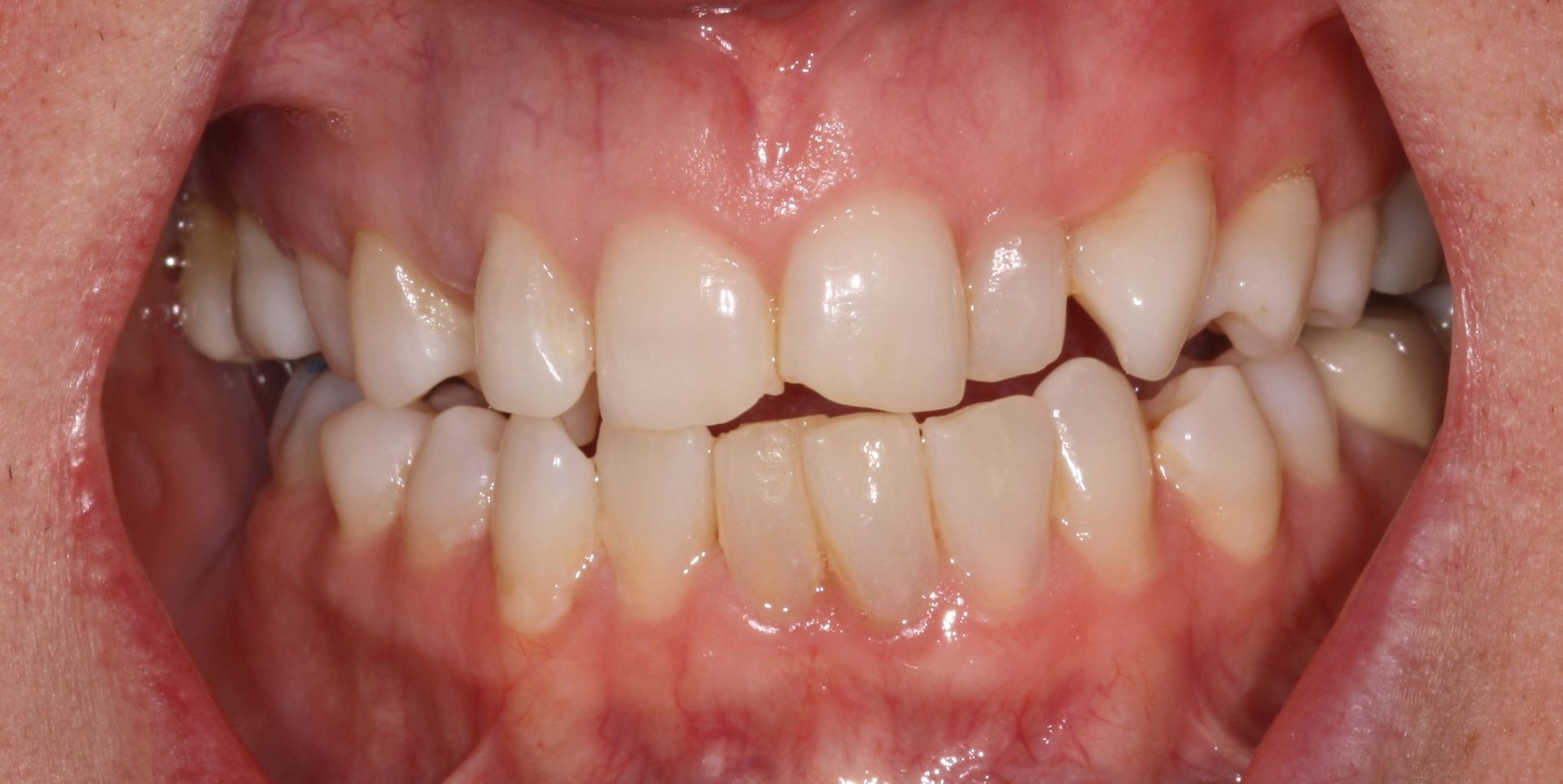 A close-up of a person's teeth with a broken tooth - before