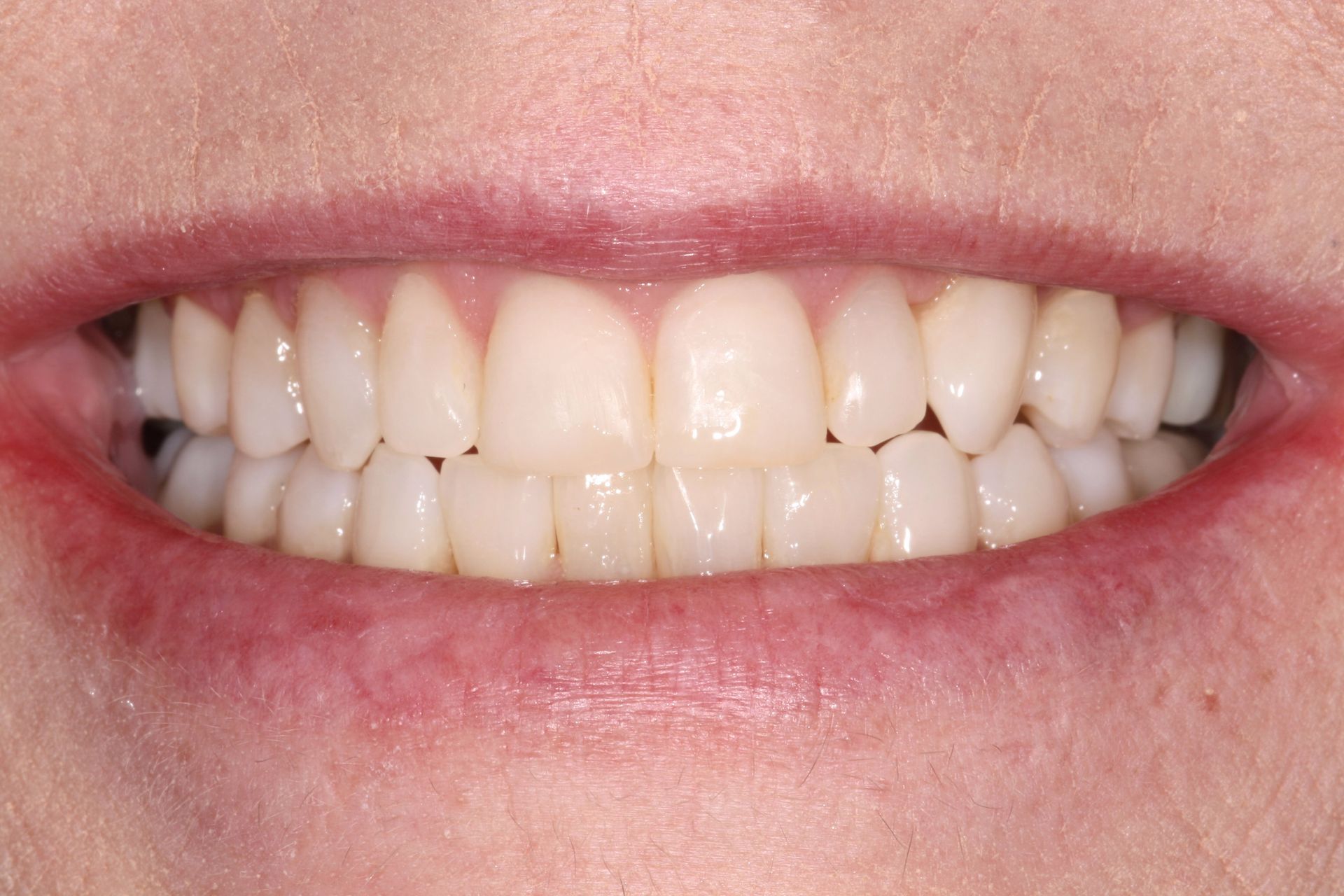 A close-up of a person's mouth with white teeth - during