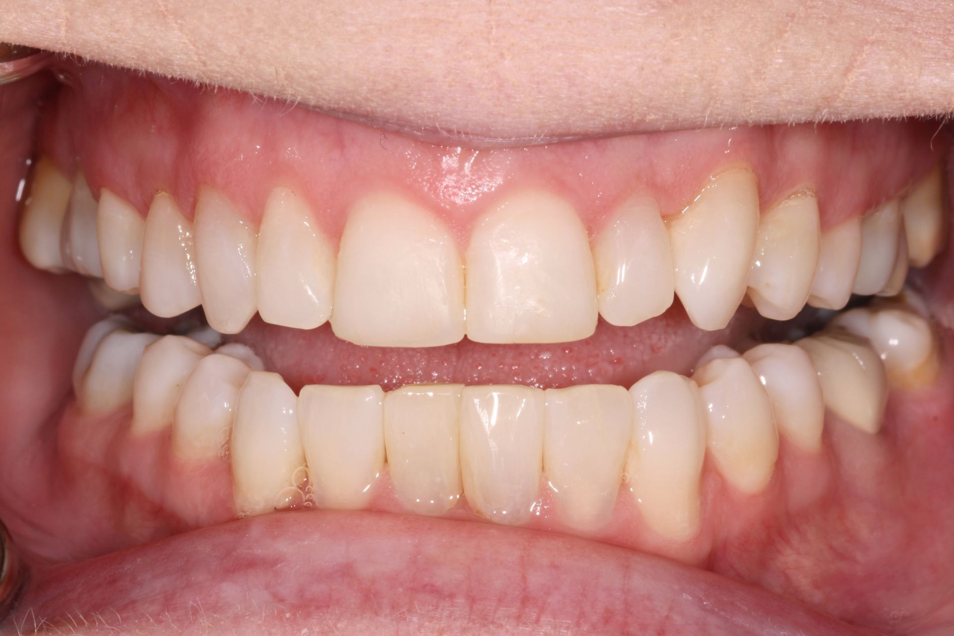 A close-up of a person's teeth with white teeth - after