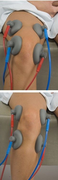A person is getting electrotherapy on their knee.