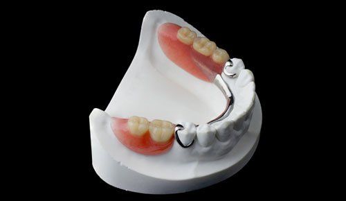 Removable partial dentures