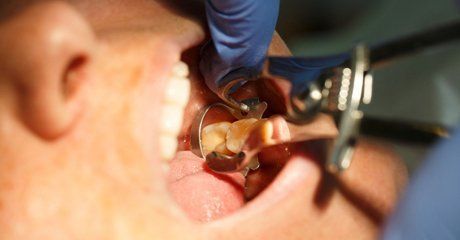 Tooth extraction process