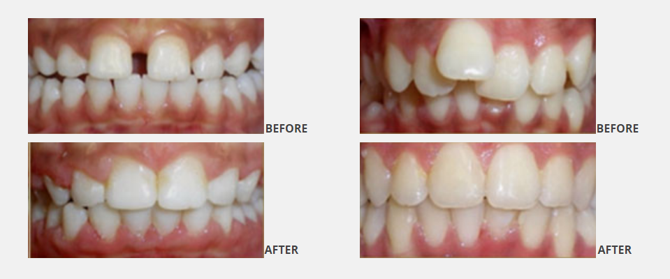 Before and after the dental treatment