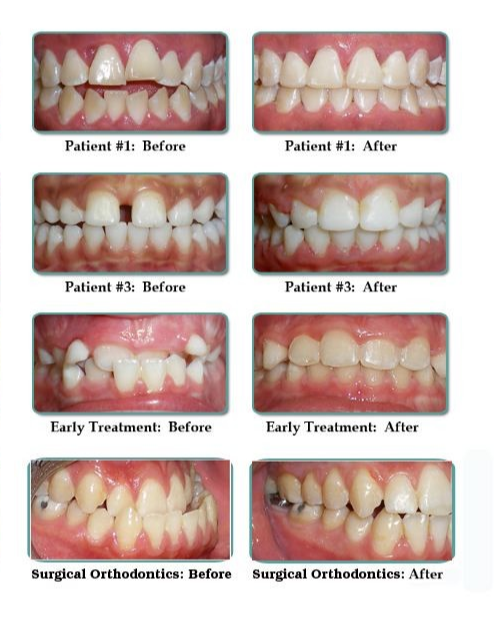 Before and after the dental treatment