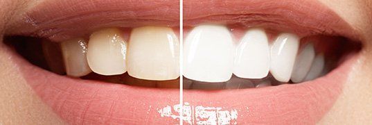 White Teeth