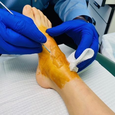 Child's foot treatment