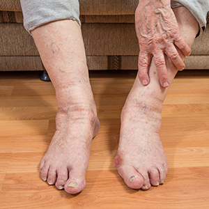 Diabetic foot