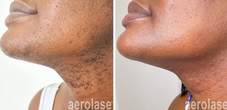 A before-and-after photo of a woman's neck and chin.