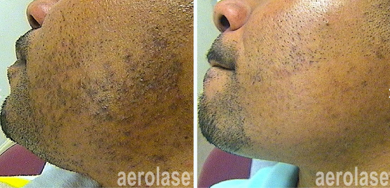 Two pictures of a man's face before and after aerolase treatment