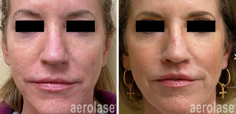 A before-and-after photo of a woman's face.