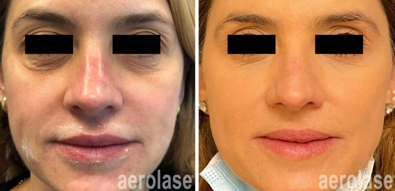 A before-and-after photo of a woman's face.