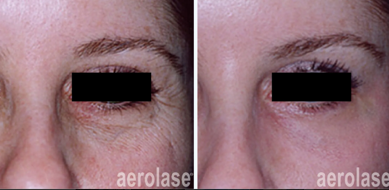 A before-and-after photo of a woman's face with aerolase written on the bottom.
