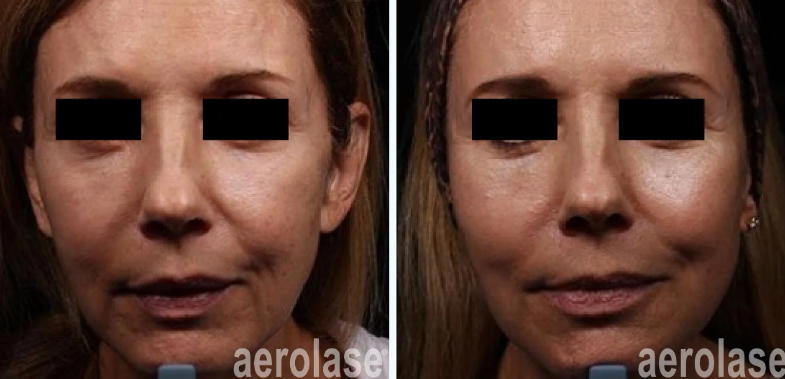 A before-and-after photo of a woman's face.