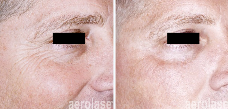 A before-and-after photo of a man's face with wrinkles.