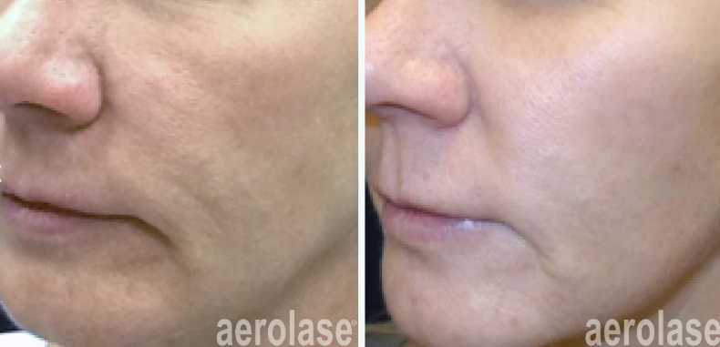 Two pictures of a woman's face before and after Aerolase treatment